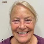 after_skin_cancer